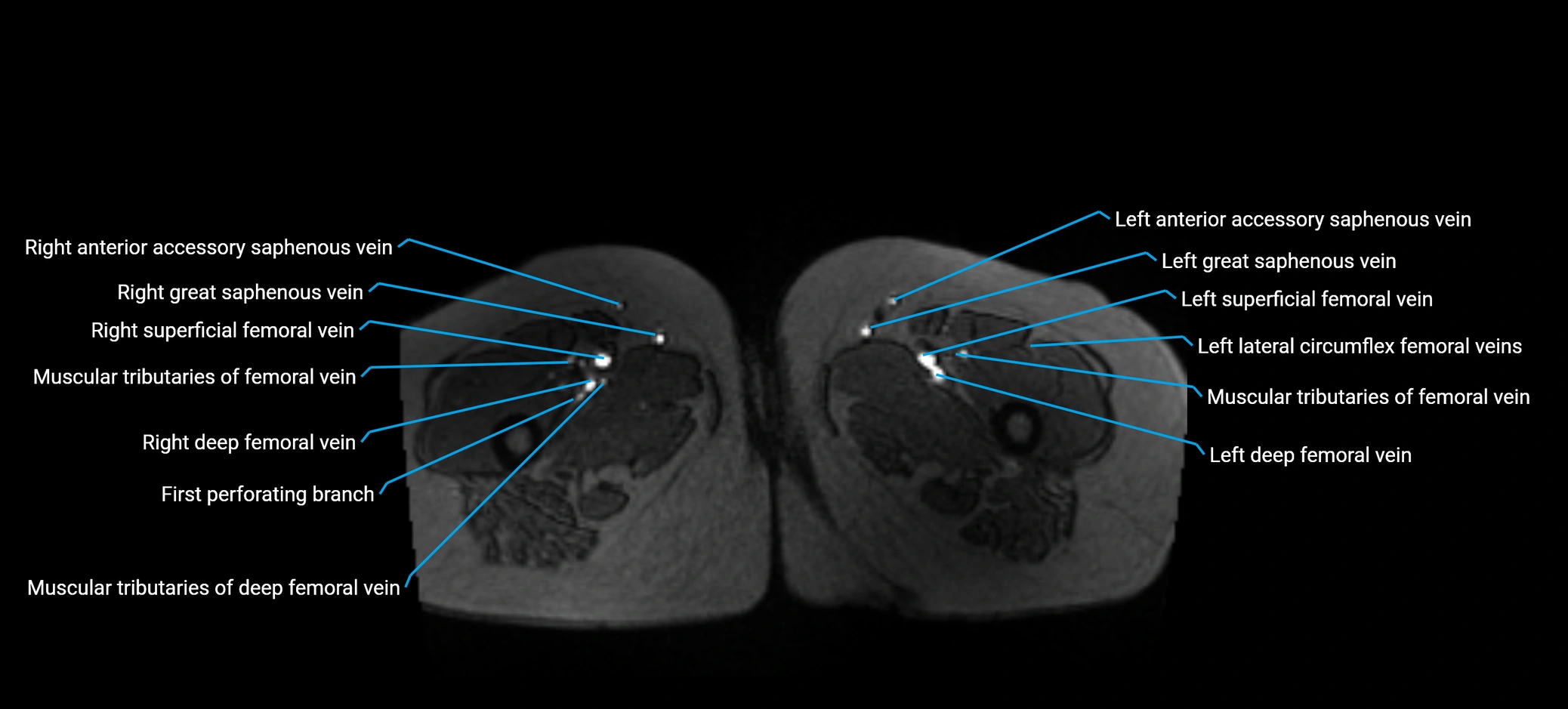 MRV abdomen pelvis & lower limb axial cross sectional anatomy labelled MRI image 220 (1).webp